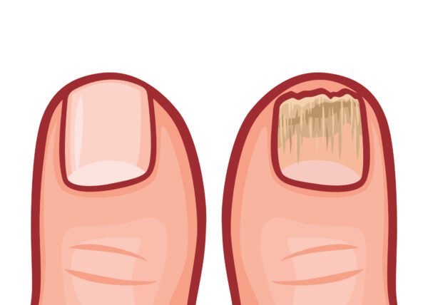 μυκητίασηΝυχιών e1710236362181