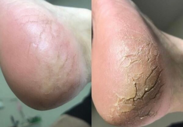 ραγάδες αγρίνιο e1709655108869